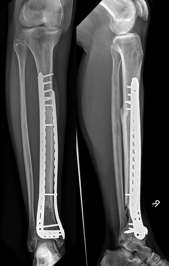 RTG snímek 1,5 roku po operaci, kde je vidět zhojení obou osteotomií