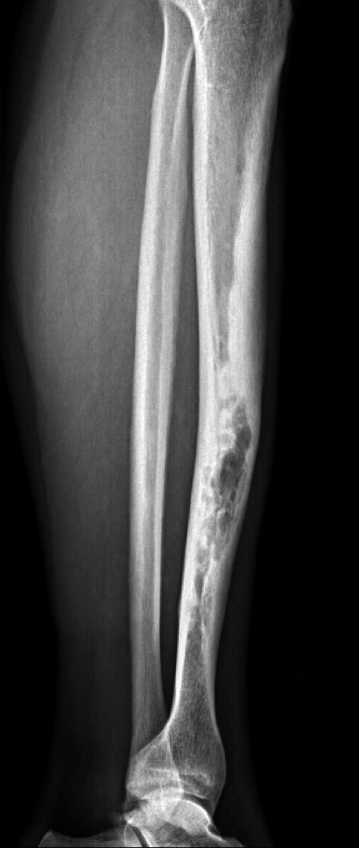 RTG snímek, kde je vidět kost postižená osteofibrózní dysplázií s okrskem agresivní destrukce v jejím centru
