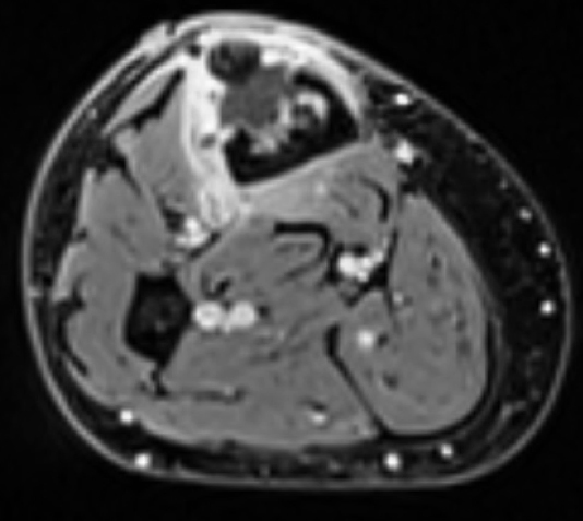 MRI obrázek - je vidět agresivní chování nádoru, který destruuje kost a šíří se do měkkých tkání