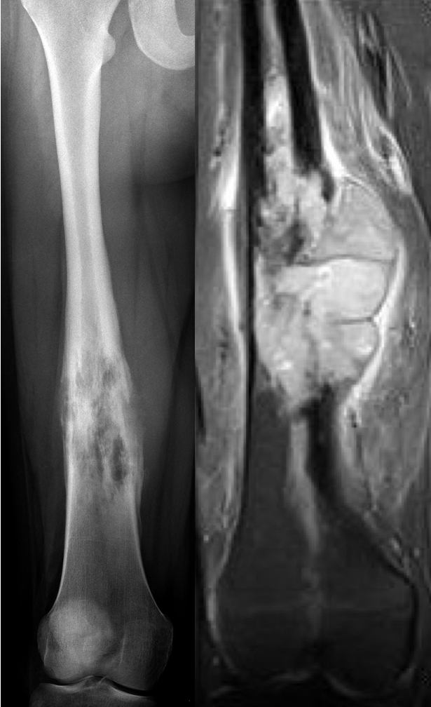 RTG a CT zobrazní maligního nádoru diafýzy stehenní kosti