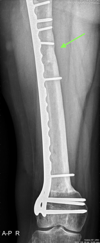 plná integrace kostního štěpu, šipka ukazuje remodelaci schodovité osteotomie. pacientka mezitím dospěla a její stehenní kost už tak "dorostla" velikostně původně větší alloštěp