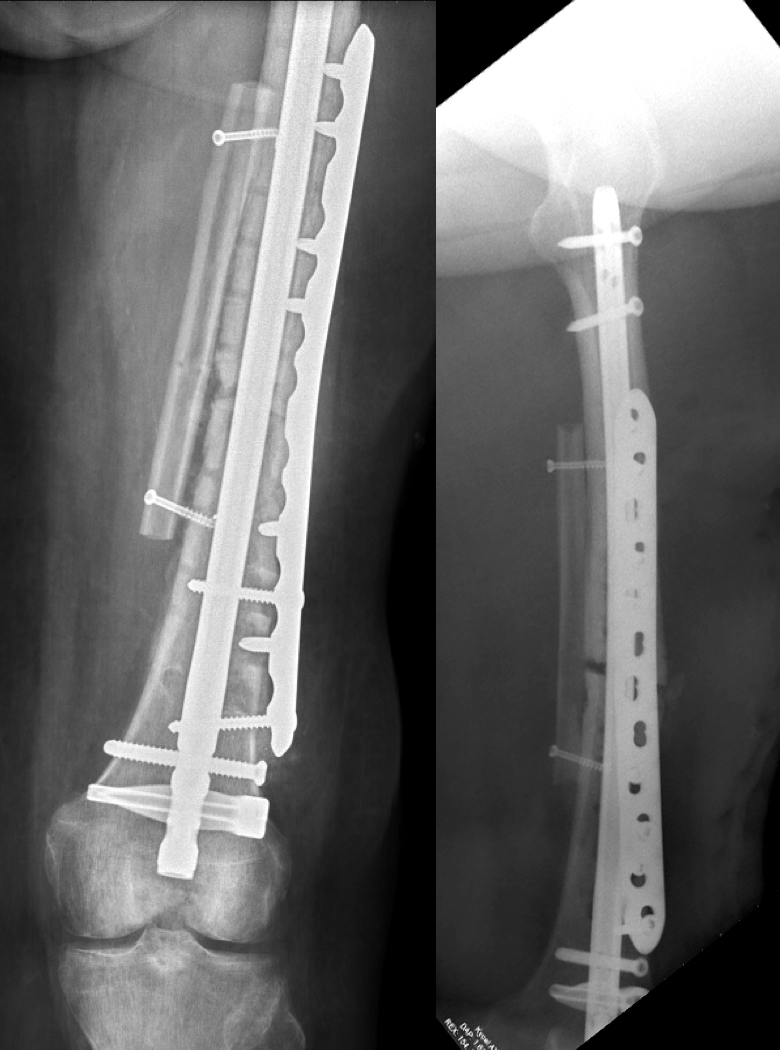 Byla provedena duální osteosyntéza a do inkriminovaného místa přenesena vaskularizovaná fibula, která byla položena paralleně s pvodní kostí