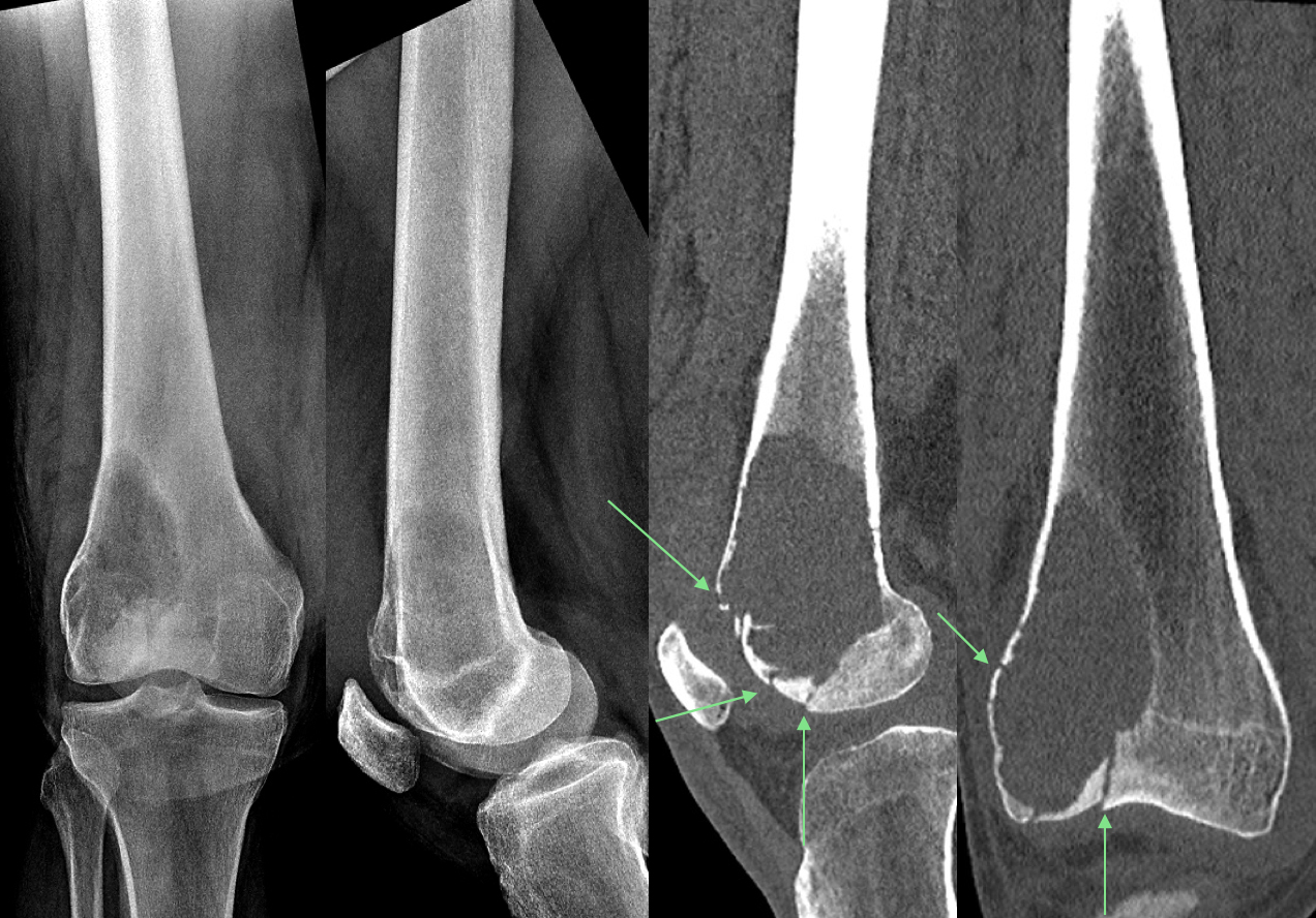 RTG a CT snímky v okamžiku diagnózy. Je patrna rozsáhlá destrukce kosti a patologická zlomenina s prolomením kloubní plochy (šipky)