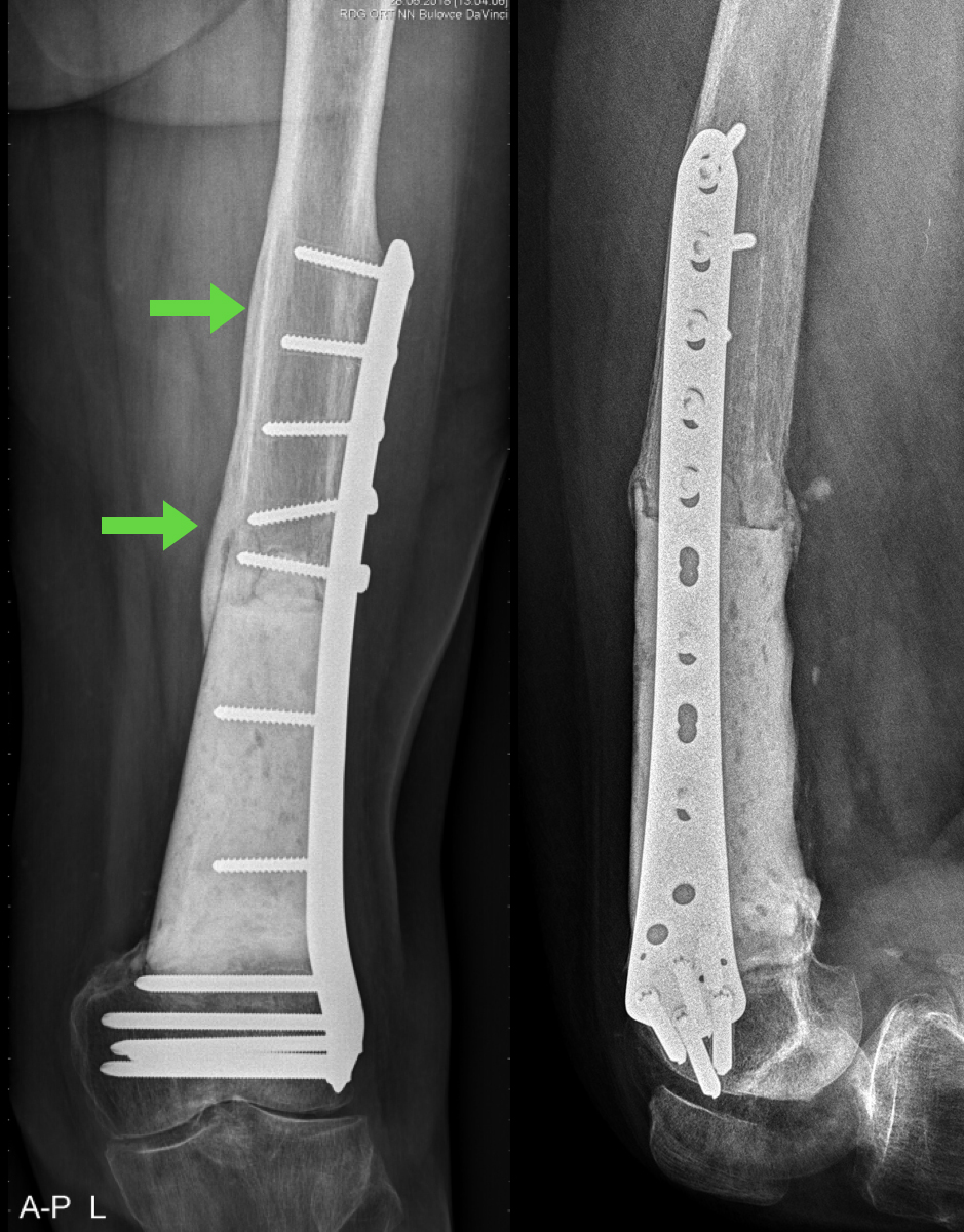 RTG ukazující hypertrofii a remodelaci kosti kolem zatěžovaného cementového spaceru (zelené šipky)