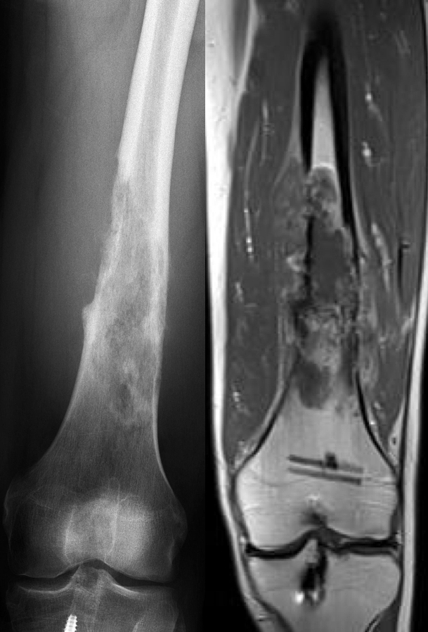 RTG a MRI ukazující agresivní tumor destruující distální 2/3 diafýzy stehenní kosti. Epifýza (kost těsně nad kloubem) není zasažena.
