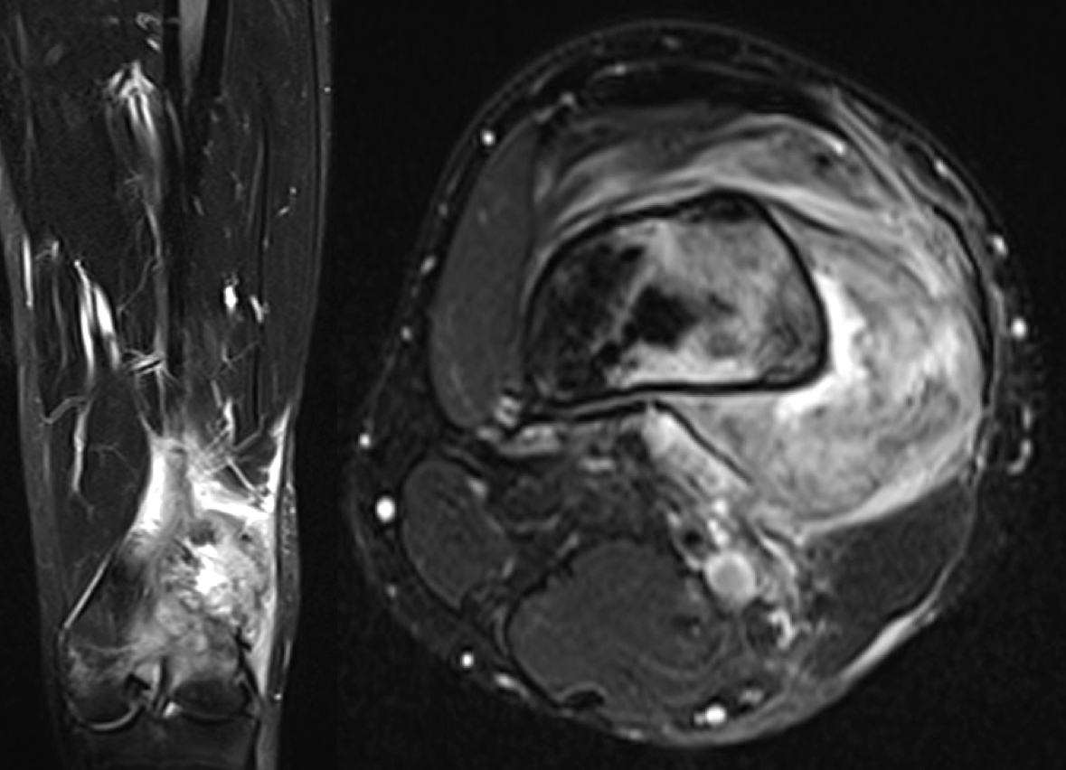 MRI ukazující nádor distálního femuru s velkou extraosseální složkou (šířením mimo kost)
