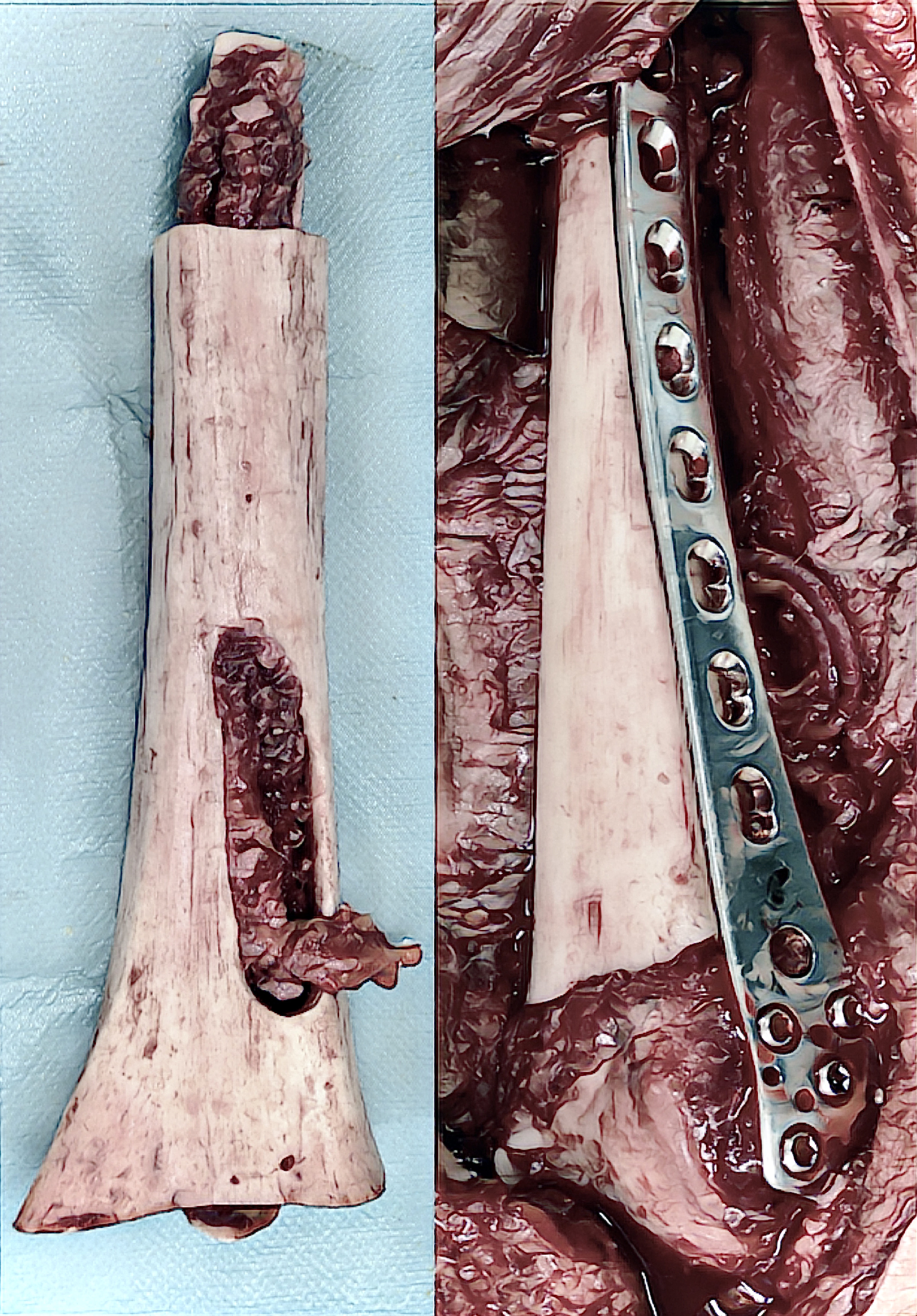 peroperační klinické foto: způsob provlečení fibuly a finální rekonstrukce po napojení mikroanastomózy