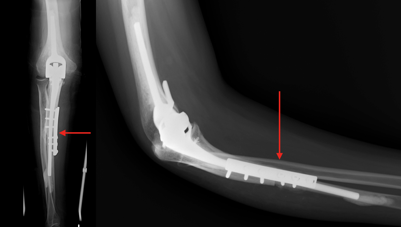 Pooerační RTG - šipky ukazují na místa kde se alloštěp setkává s původní kostí