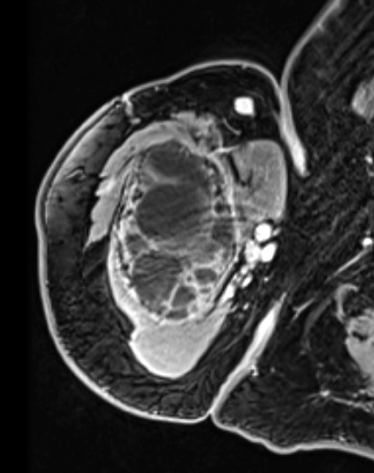 transversální MRI ukazující objem nádoru