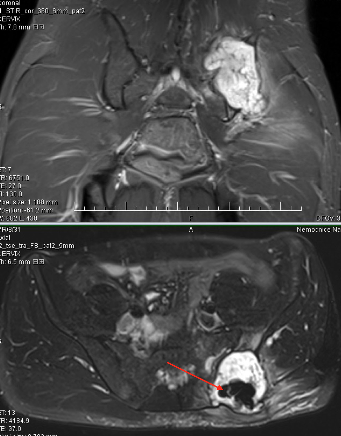 MRI nádoru nasedajícího na SI kloub, šipka ukazuje na cement po biopsii