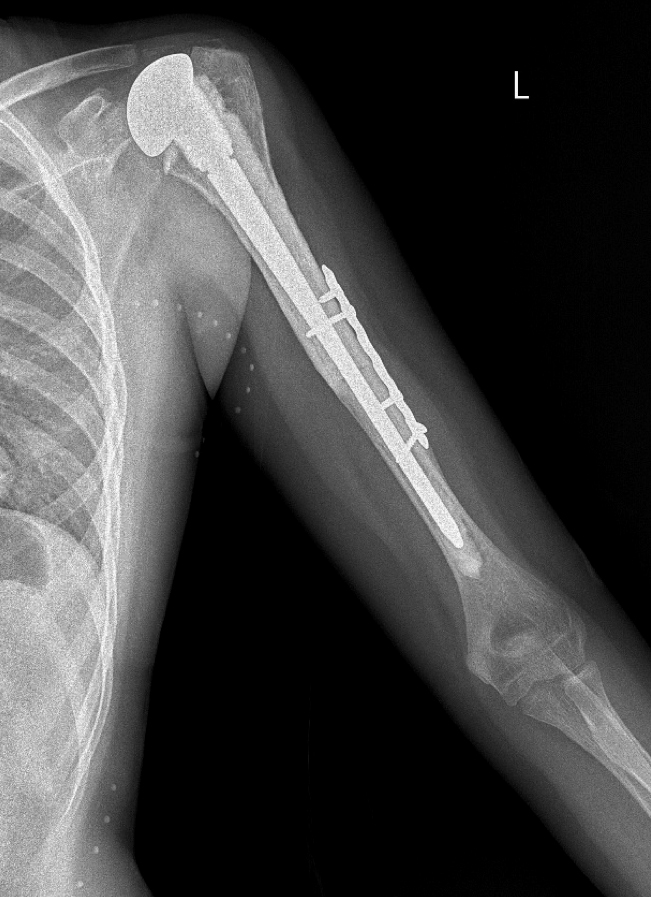 RTG 2 roky po operaci - je vidět splynutí alloštepu s hostí pacientky a centrovaný rammení kloub