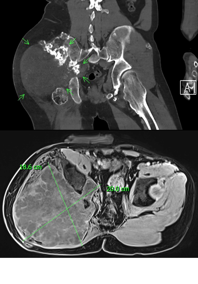 CT a MRI ukazující rozsah tumoru