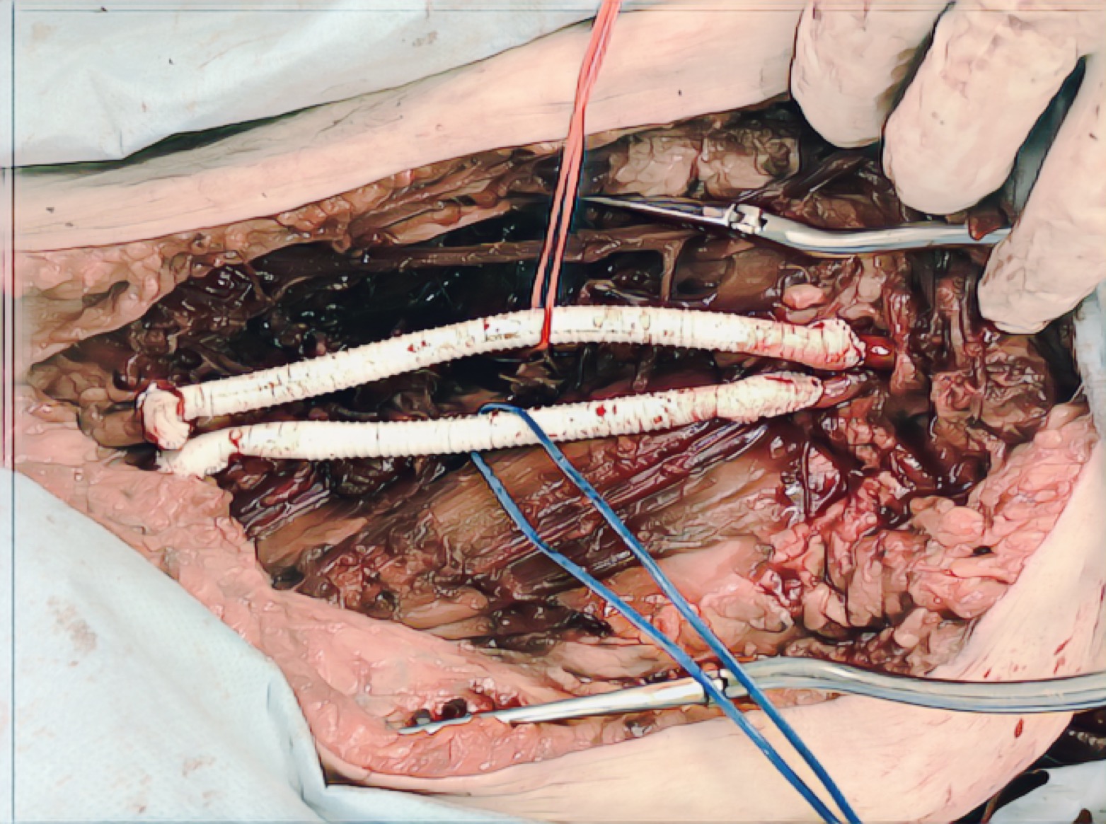 perioperační foto cévní rekonstrukce