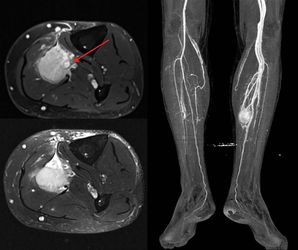 MRI (vlevo) ukazující infiltraci cévního svazku (šipka). CT-AG (vpravo) ukazuje, že do periferie končetiny vede jediná tepna.