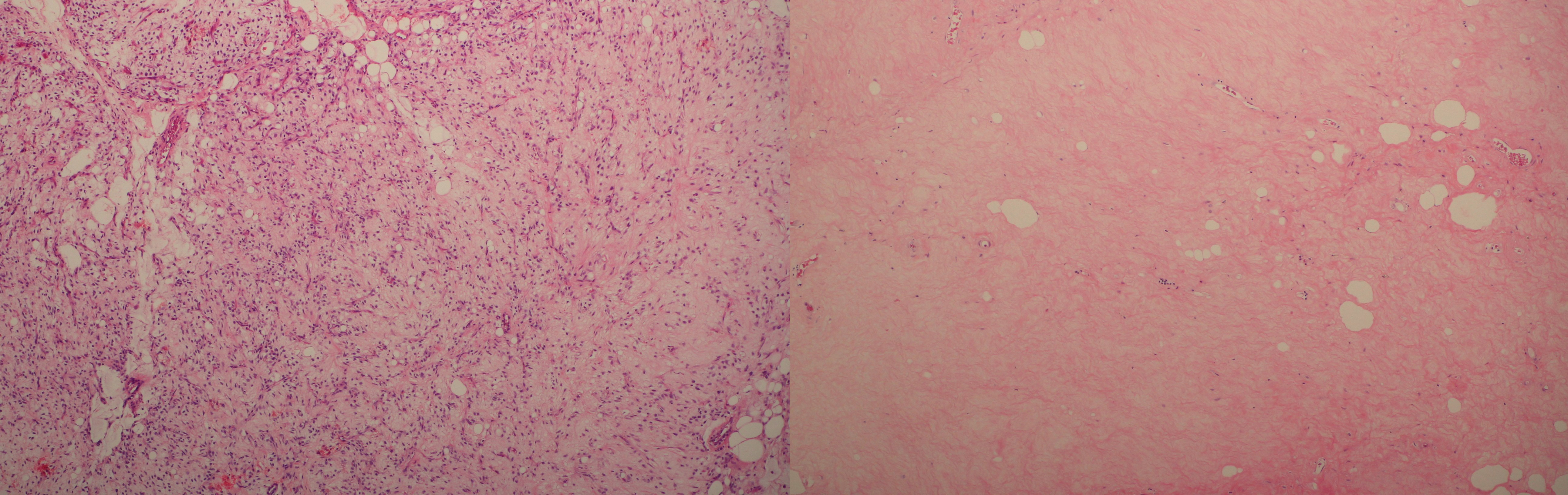 Histologický obraz před a po HILP : bylo dosaženo 99% nekrózy tumoru