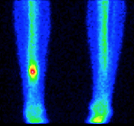 SPECT (single photon emission computed tomography) - vyšetření na nukleární medicíně, které zobrazuje vysokou metabolickou aktivitu ložiska
