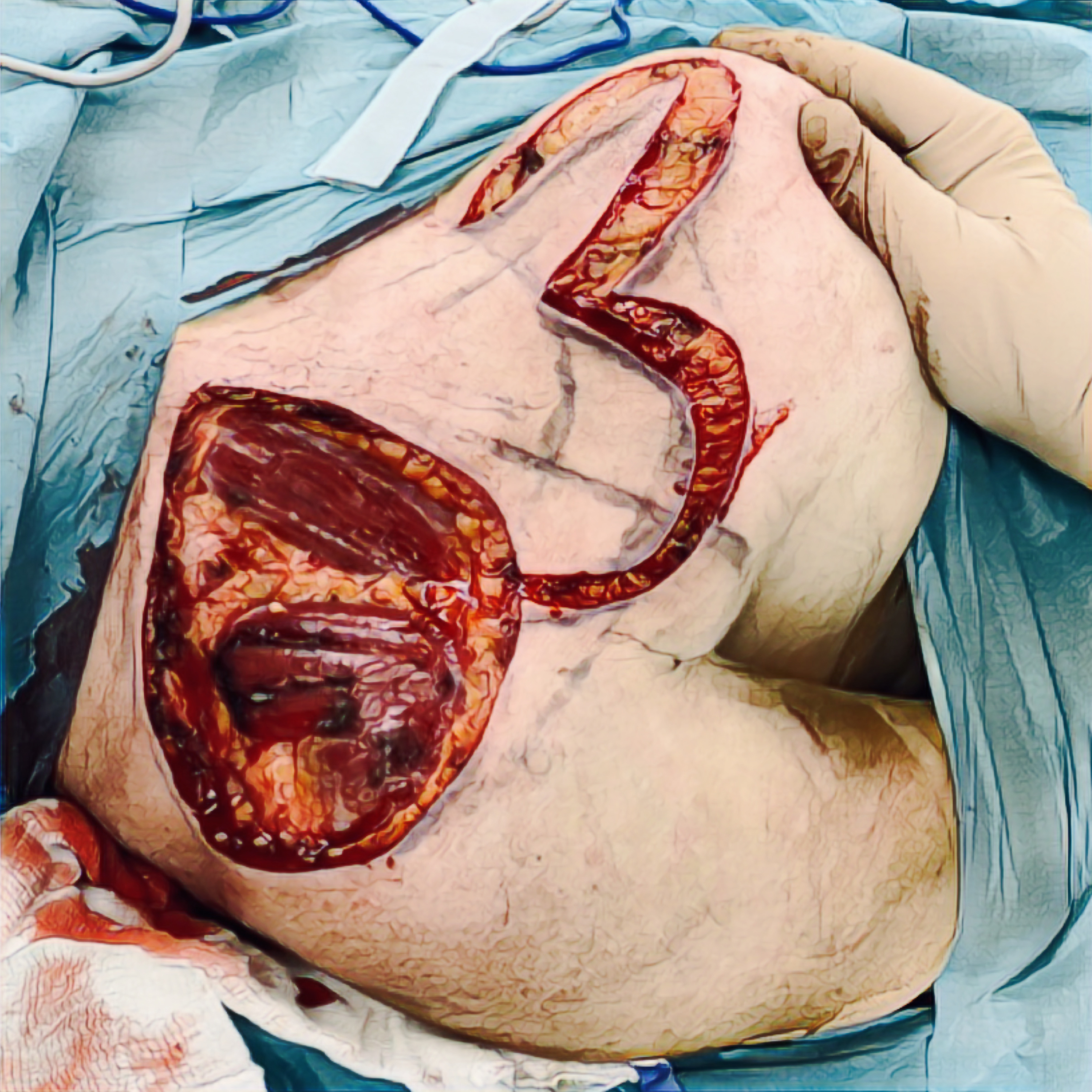 Perioperační foto: rozsah vzniklého defektu po reskci s naznačeným kožním dvoj-lalokem před posunem