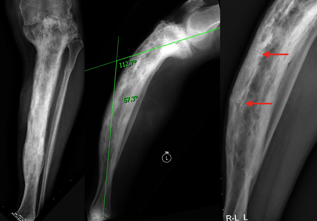 RTG ukazující předoperační angulaci 67st. Červené šipky ukazují na bolestivé únavové zlomeniny (Looserovy zóny přestavby) vznikající v důsledku mechanicky nevýhodného tvaru kosti.