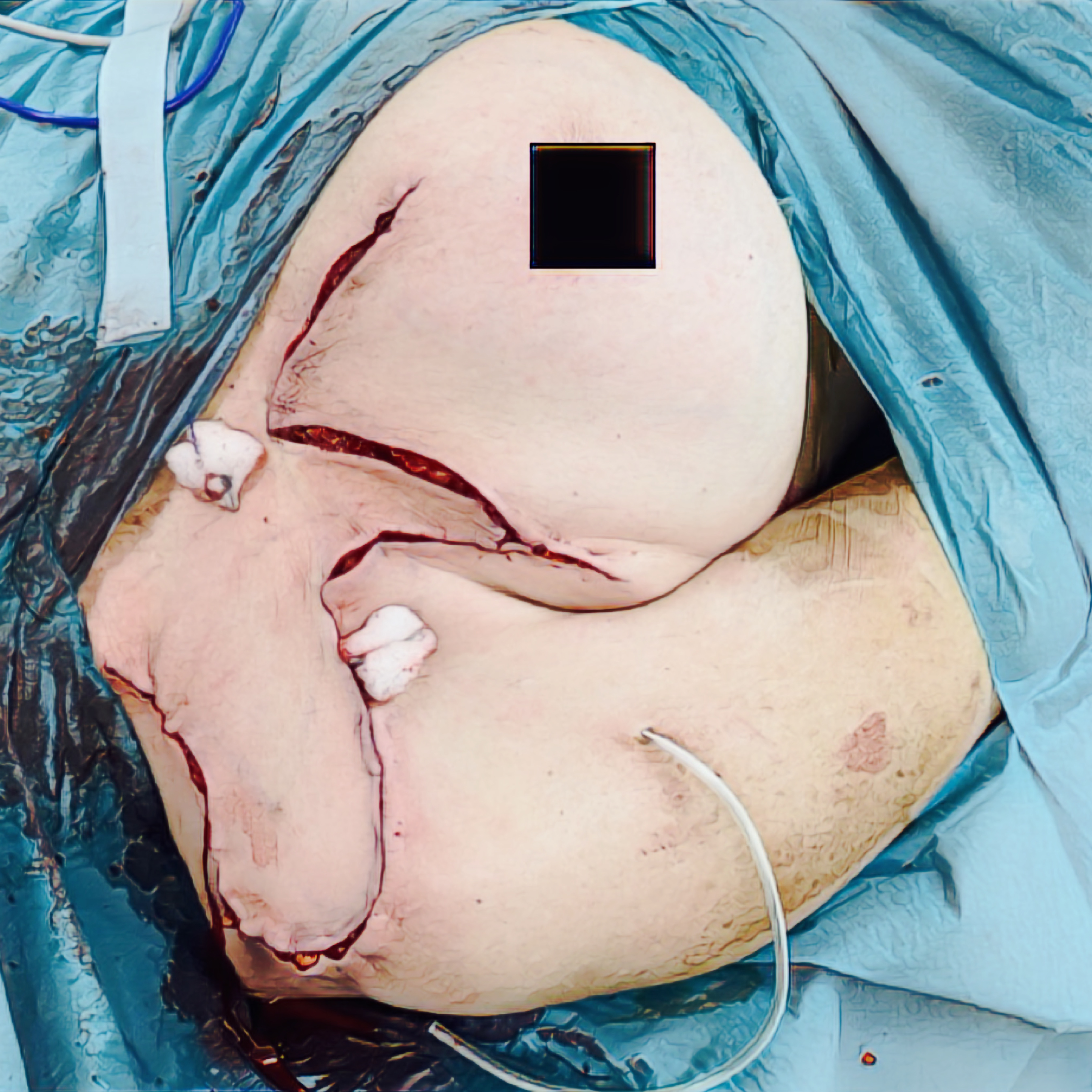peri-operační foto po rotaci laloku do defektu