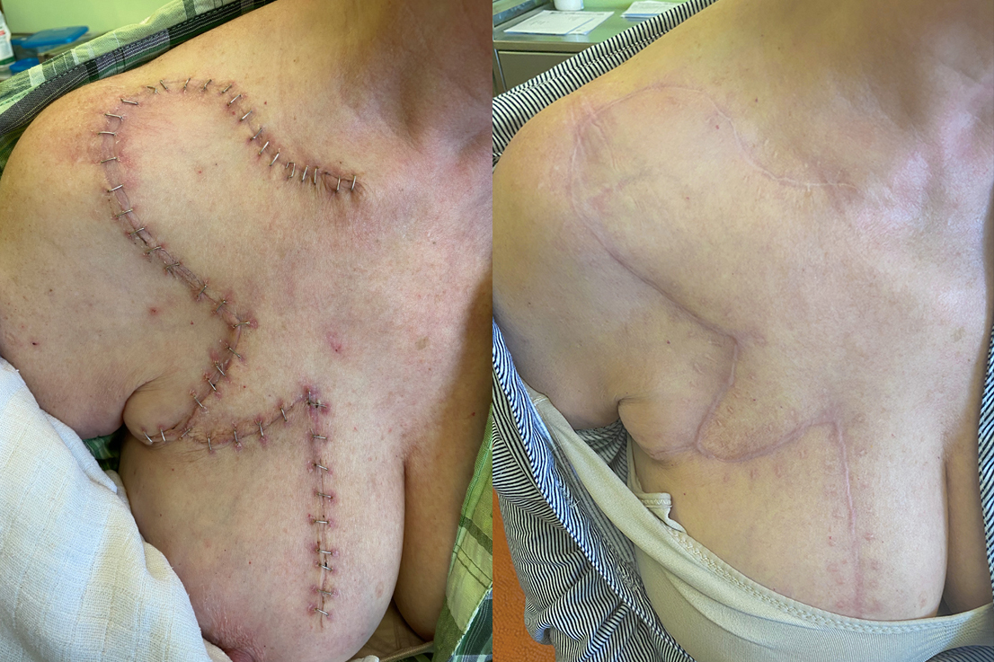 Klinický obrázek hojení laloku krátce po operaci a na kontrole po 2 letech