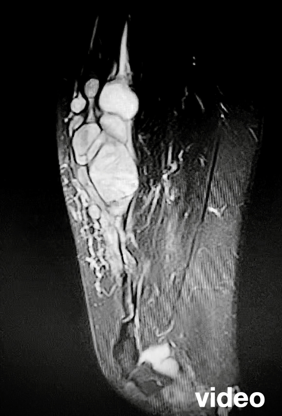 MRI video rozsahu infiltrace stehna tumorem