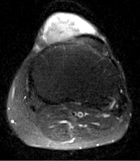 MRI ukazující infiltraci přední strany kolene včetně šlachy a úponu lig.patellae