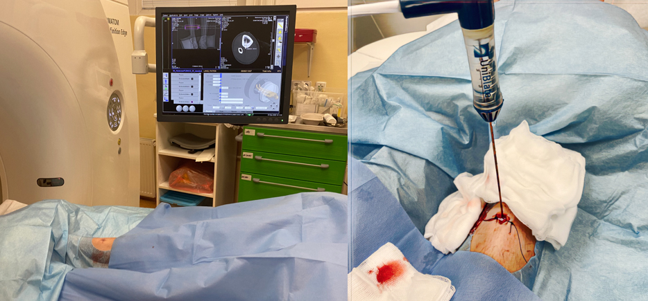 Procedura RFA probíhající v CA pod kontrolou CT