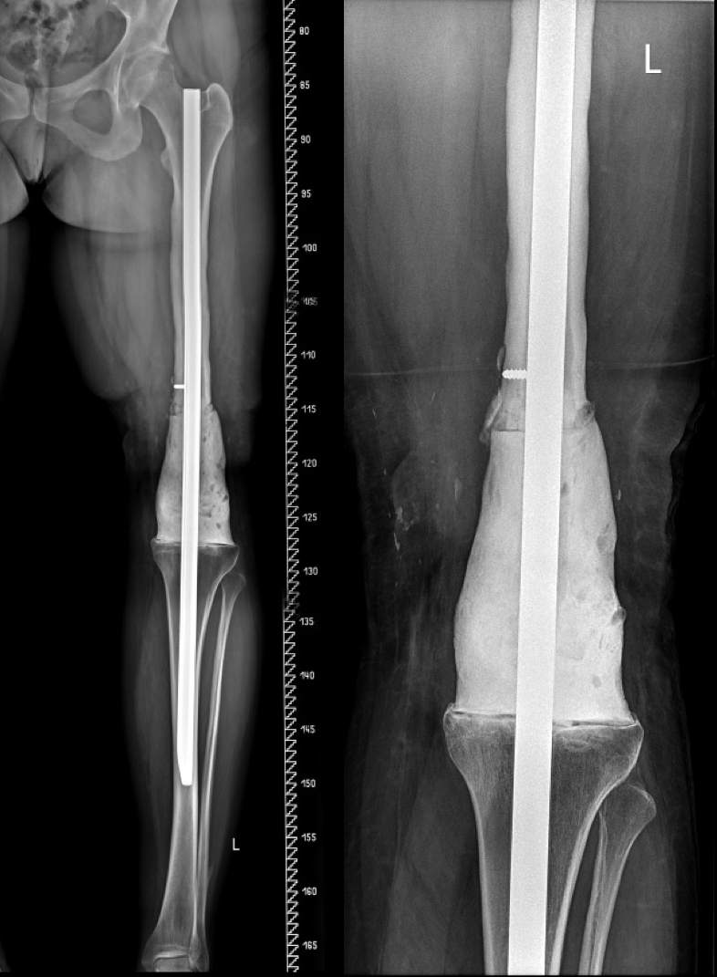 Stav po resekci infikované kosti a déze kolene na Kü-hřebu