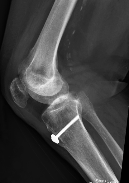 RTG rekonstrukce - bloček kosti patní kosti byl využit k zakotvení AŠ v tibii a je fixován šroubem