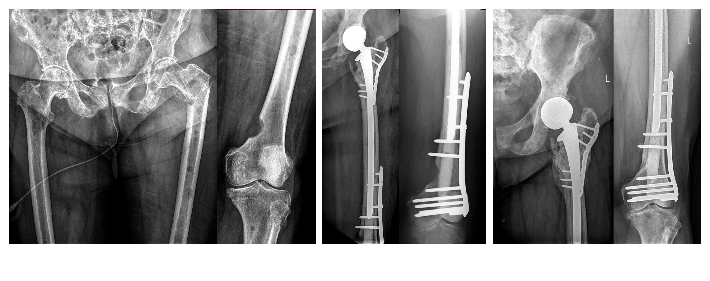 Příklad rozsáhlého postižení celé stehenní kosti, kdy pomocí LSH a dlahy je stabilzována celá stehenní kost a i 2r po operaci plně nosná končetina.