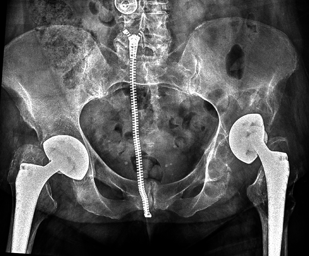 RTG zobrazující uvolnění jamky endoprotézy a rozsáhlou destrukci levé poloviny pánve granulomem