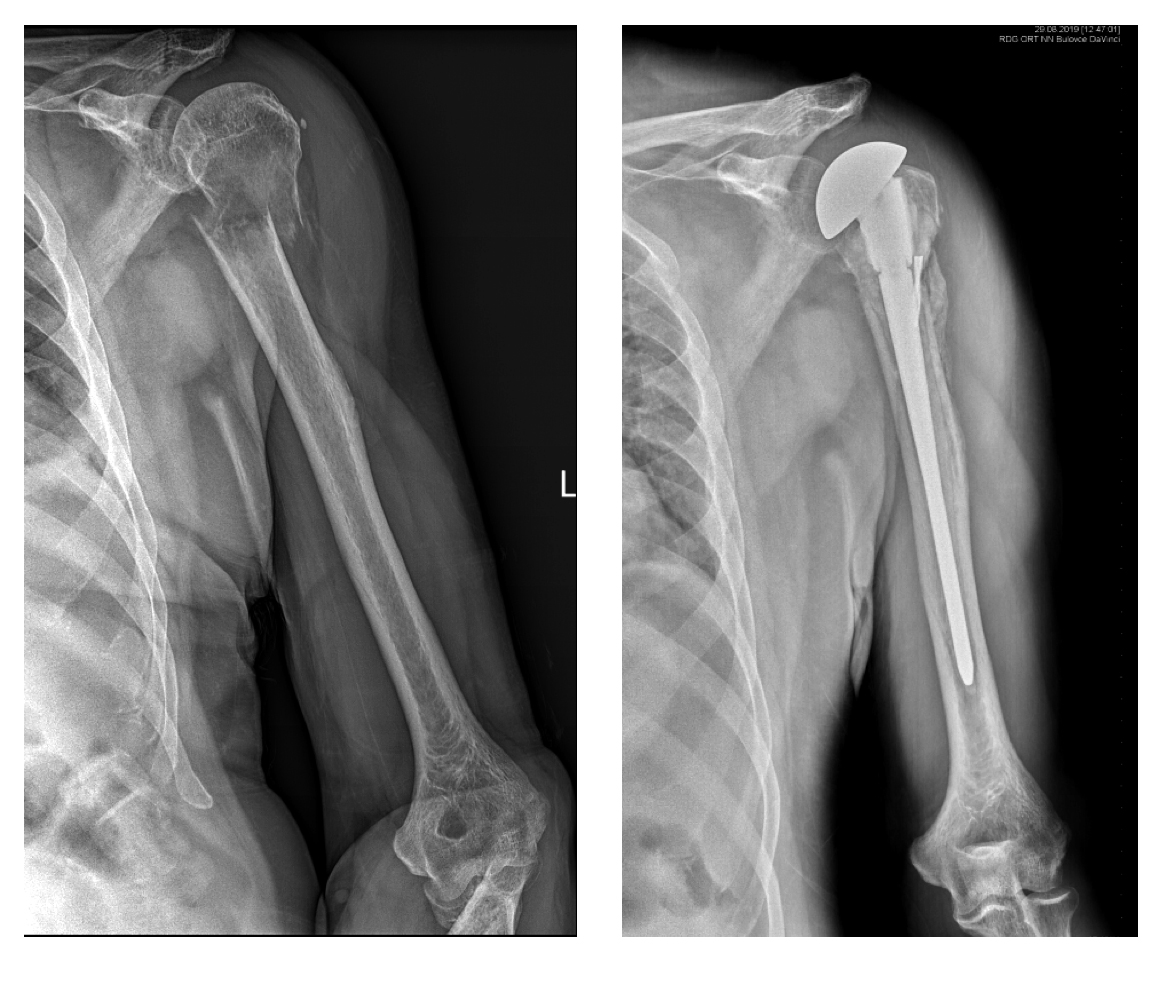 RTG ukazující patologickou zlomeninu pažní kosti a rekonstrukci na kontrolním RTG rok po operaci