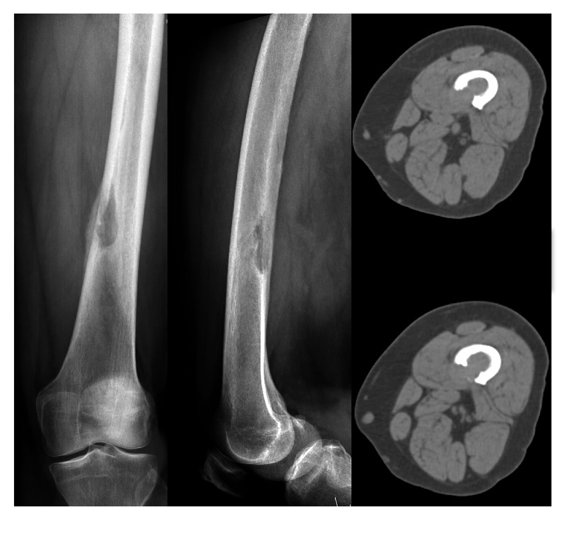 RTG a CT zobrazující nádorovou usuraci a oslabení diafýzy stehenní kosti
